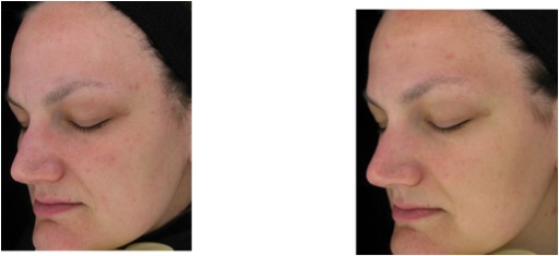 Effects of Oral Supplementation With Methylsulfonylmethane on Skin Health  and Wrinkle Reduction | Natural Medicine Journal